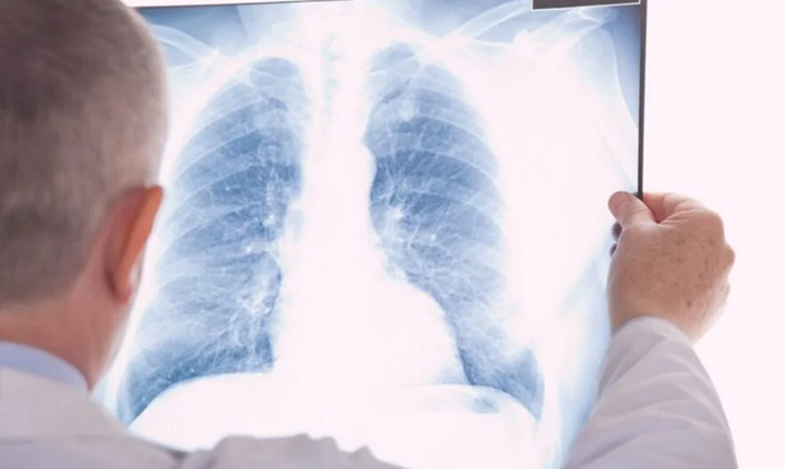 Câncer de pulmão: novo medicamento impede progressão em 60% dos pacientes