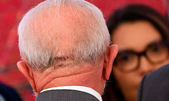 Entenda o que é a craniotomia, procedimento ao qual Lula foi submetido