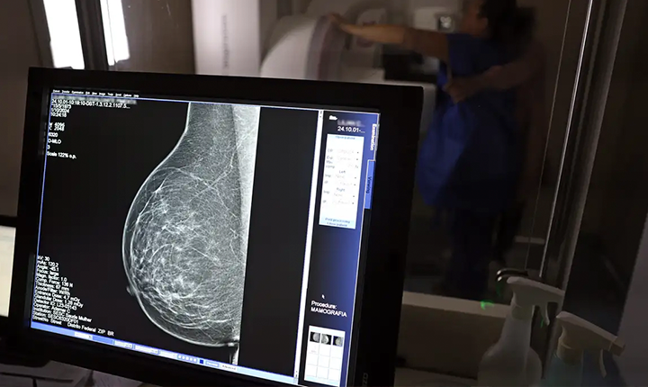 Câncer de mama: uma em cada três pacientes tem menos de 50 anos